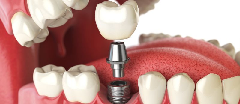 best dental implants