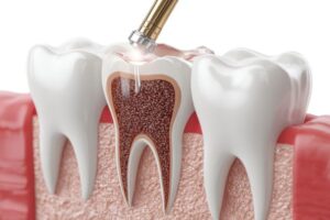 Root Canal or extraction